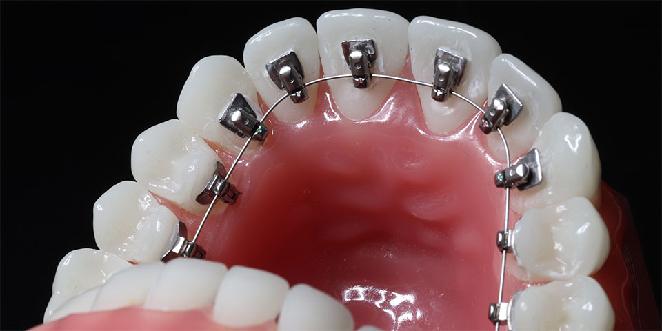 裏側矯正の実績多数・難症例も対応