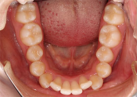 下の歯